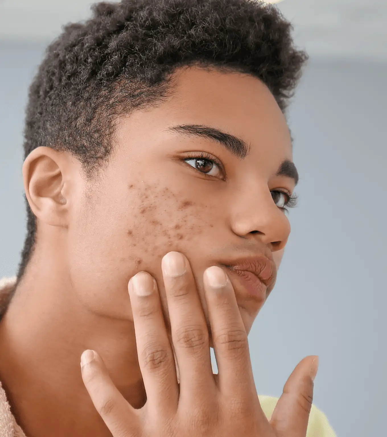 Acne (Teen, Adult, Hormonal)